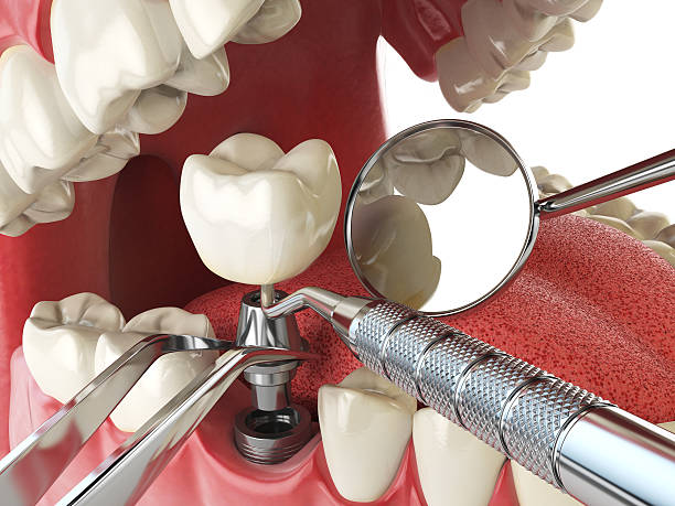 Best Emergency Treatment for Dental Infections or Abscesses in Crownsville, MD